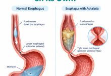 Medical illustration showing achalasia with a tight lower esophageal sphincter and food retention in the esophagus.