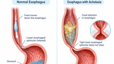 Medical illustration showing achalasia with a tight lower esophageal sphincter and food retention in the esophagus.