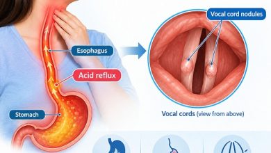 Medical illustration of vocal cord nodules and reflux-related irritation of the larynx.