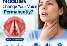 Medical illustration of the vocal cords showing nodules that may cause hoarseness and changes in voice quality.