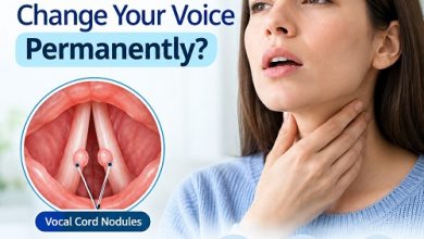Medical illustration of the vocal cords showing nodules that may cause hoarseness and changes in voice quality.