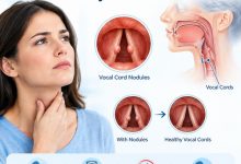 Medical illustration showing benign vocal cord nodules on the vocal folds and their effect on normal voice production.