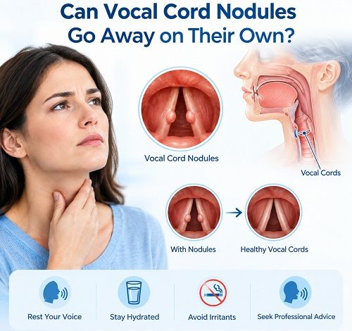 Medical illustration showing benign vocal cord nodules on the vocal folds and their effect on normal voice production.