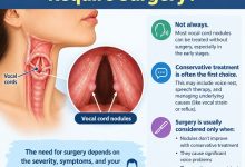 Medical illustration showing vocal cord nodules on the vocal folds inside the larynx.