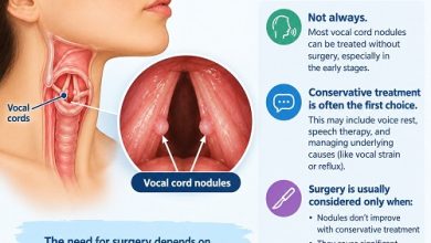 Medical illustration showing vocal cord nodules on the vocal folds inside the larynx.