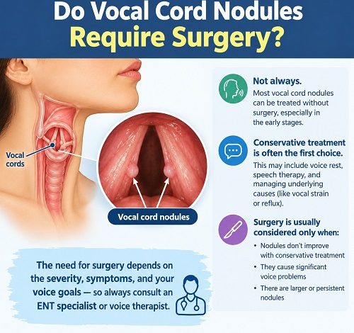 Medical illustration showing vocal cord nodules on the vocal folds inside the larynx.