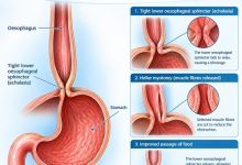 Heller myotomy for achalasia to help improve swallowing by relaxing the lower oesophageal sphincter