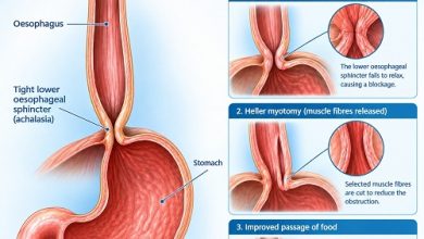 Heller myotomy for achalasia to help improve swallowing by relaxing the lower oesophageal sphincter