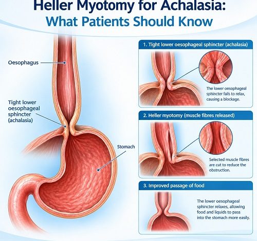 Heller myotomy for achalasia to help improve swallowing by relaxing the lower oesophageal sphincter