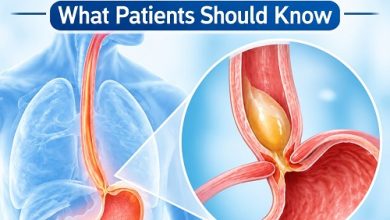 Is Achalasia a Serious Condition