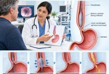 Pneumatic dilation for achalasia balloon dilation procedure illustration