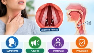 Medical illustration of vocal cord nodules on the vocal folds inside the larynx