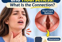 Medical illustration showing vocal cord nodules on the vocal folds and how they affect normal voice production.