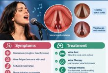 Singer experiencing vocal cord nodules and hoarseness while practising singing