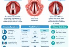 Medical illustration comparing vocal cord nodules and cysts, showing their location on the vocal folds.