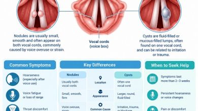 Medical illustration comparing vocal cord nodules and cysts, showing their location on the vocal folds.