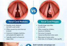 Vocal cord nodules vs polyps showing differences between two types of vocal fold lesions