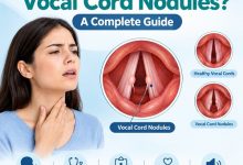 Medical illustration of vocal cord nodules on the vocal folds inside the larynx