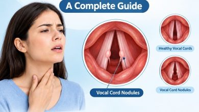 Medical illustration of vocal cord nodules on the vocal folds inside the larynx