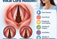 Medical illustration of vocal cord nodules caused by voice overuse and vocal strain