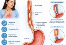 Person experiencing swallowing difficulties and chest discomfort associated with achalasia.